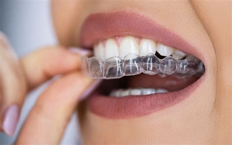 Instantly Straighten Your Teeth with a Magical Aligner